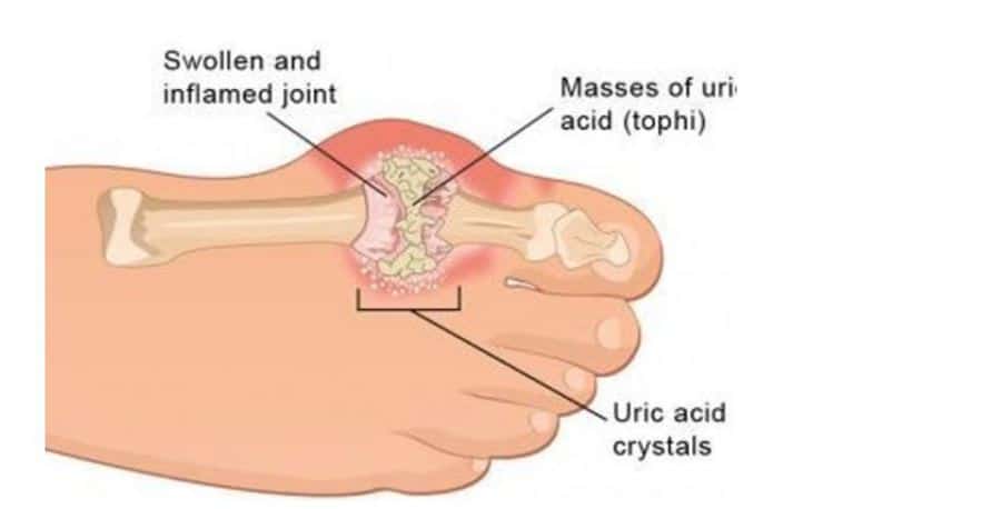gout cure: herbal remedies at home