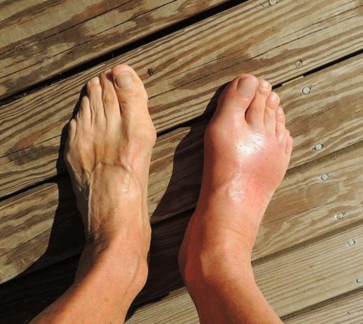 Gout CURE: herbal remedies at home